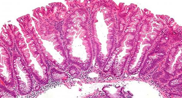 Pólipos serrados sésiles (sessile serrated polyps, SSP) y adenomas serrados tradicionales (traditional serrated adenomas, TSA)